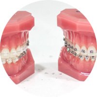 Brackets de ortodoncia