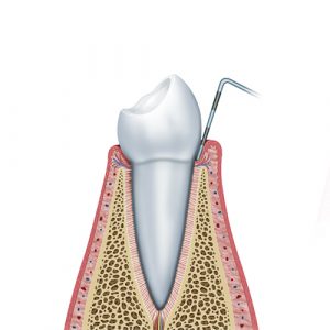 Preparación para implante dental