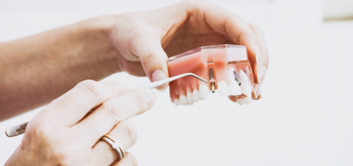 implantes-dentales-baratos-donostia