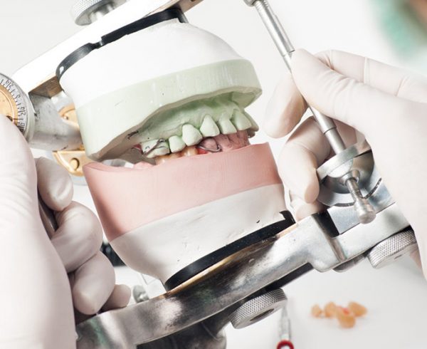 ¿Cuál es la diferencia entre las prótesis y los implantes dentales?