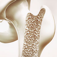 Implantes dentales osteoporosis