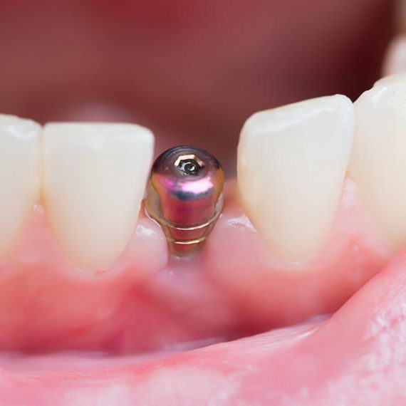¿Qué es la periimplantitis y cómo afecta a los implantes dentales?