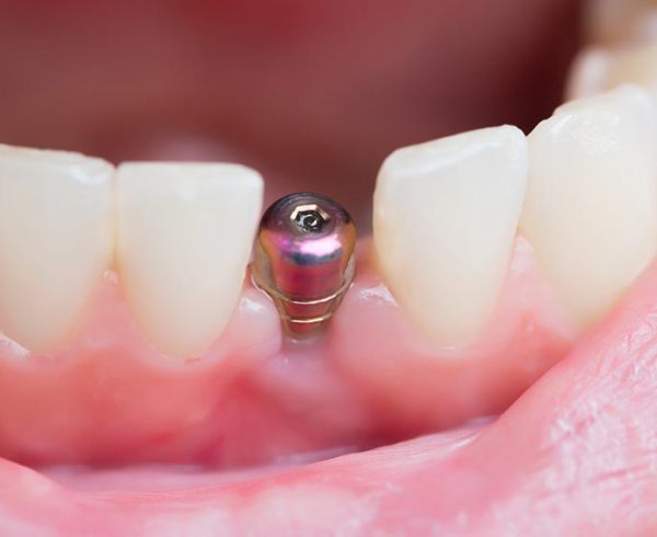 ¿Qué es la periimplantitis y cómo afecta a los implantes dentales?